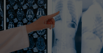 Pneumonia Classification Challenge by Segmind